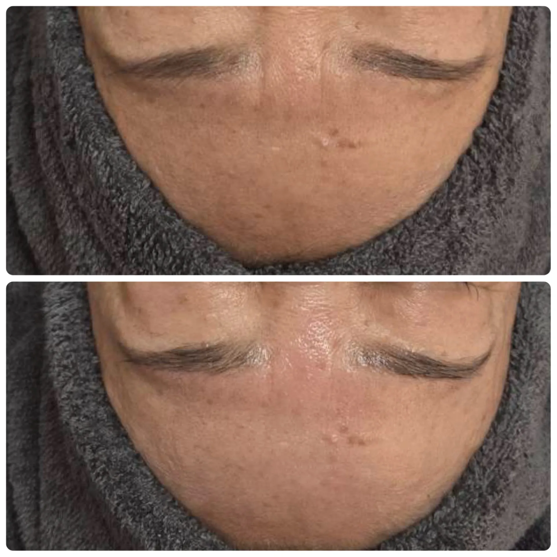 ハーブピーリングの効果です♪